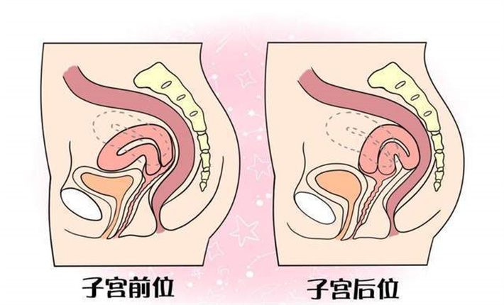 子宫后位