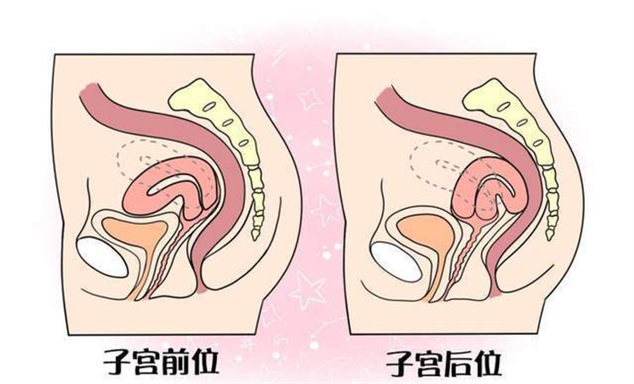 子宫后位.png