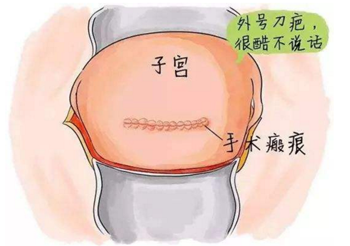 子宫疤痕