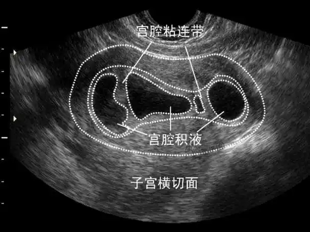 宫腔积液