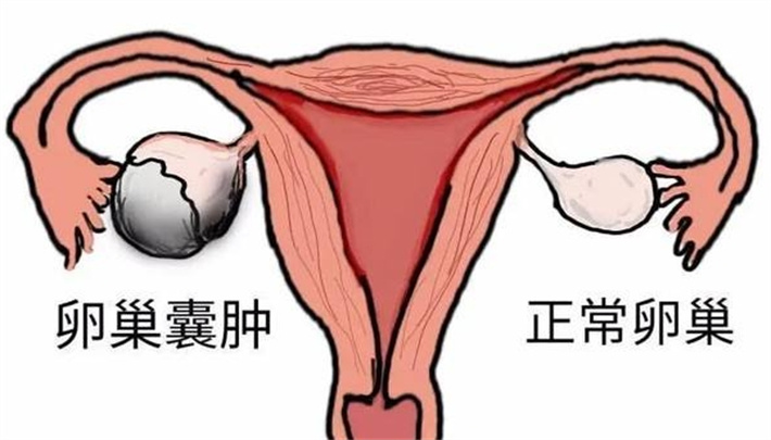 卵巢囊肿