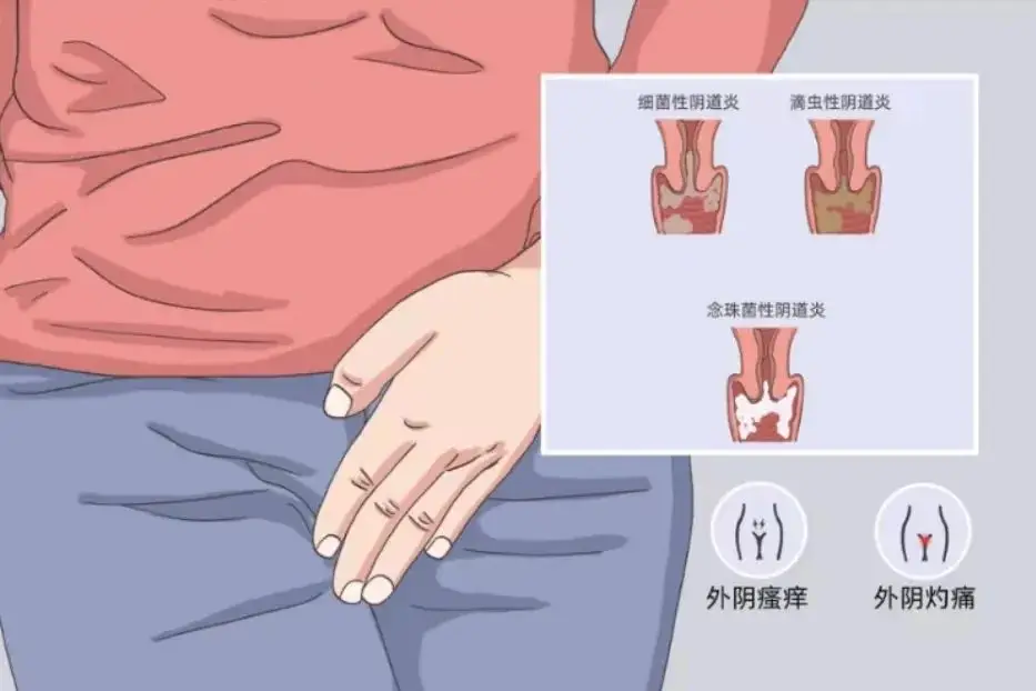阴道炎