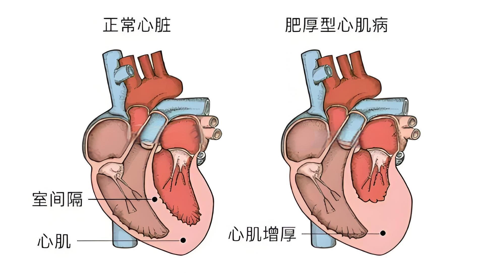 肥厚性心肌病