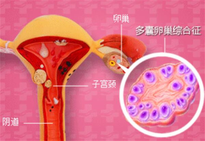 多囊暖巢综合征