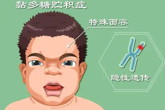 黏多糖贮积症