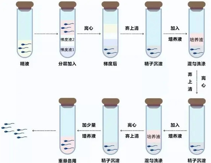 梯度离心精子洗涤技术
