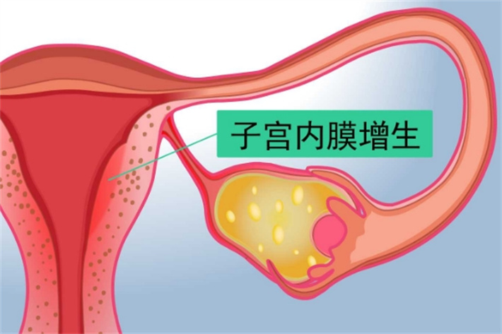 子宫内膜增生3.jpg