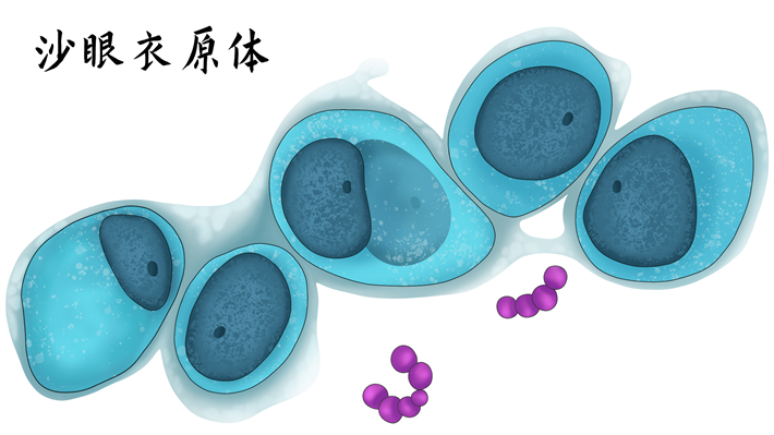 沙眼衣原体感染