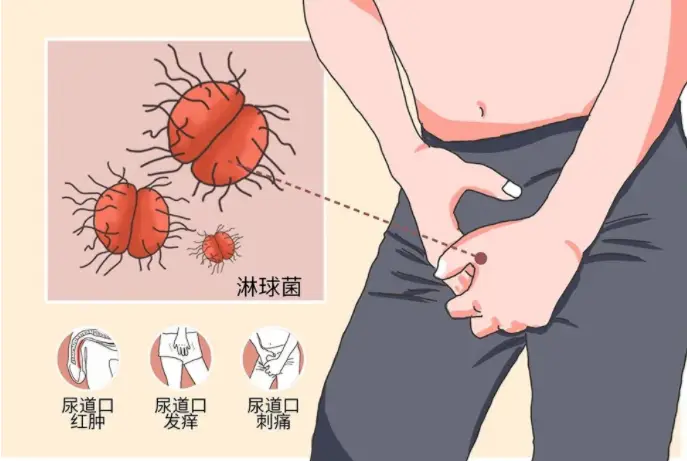 淋病病原体