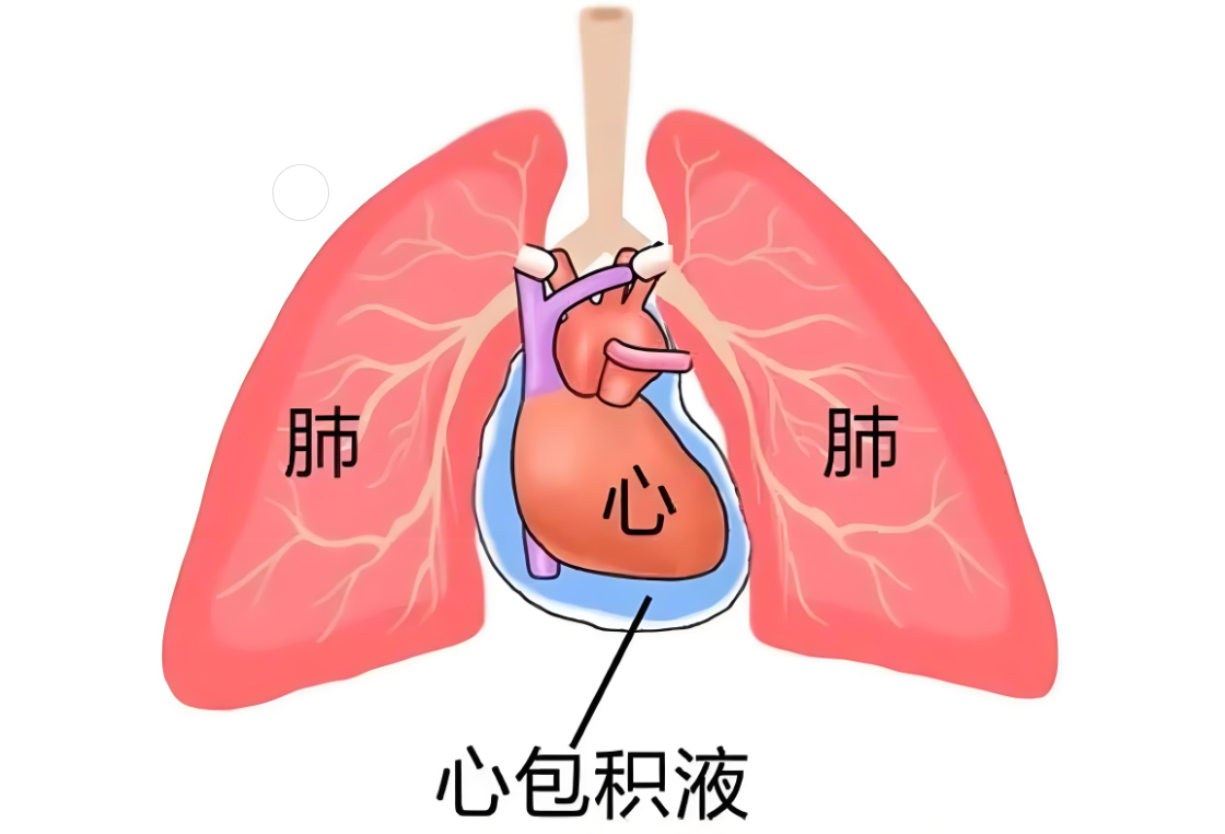 心包积液