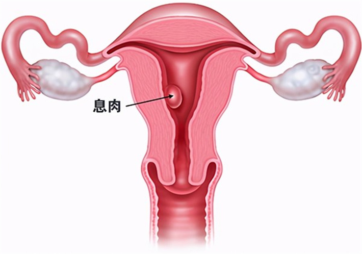 子宫内膜息肉