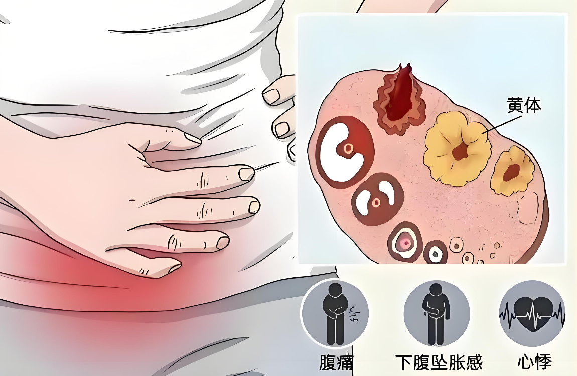 黄体血肿