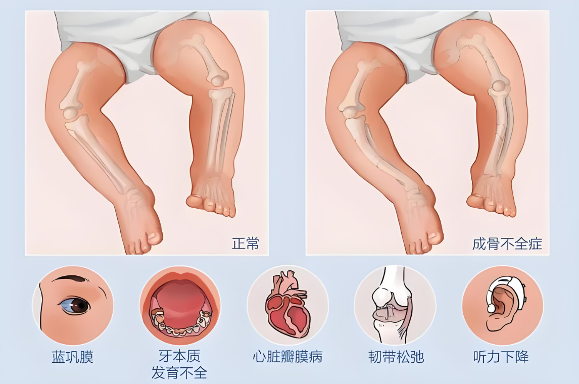 成骨不全症