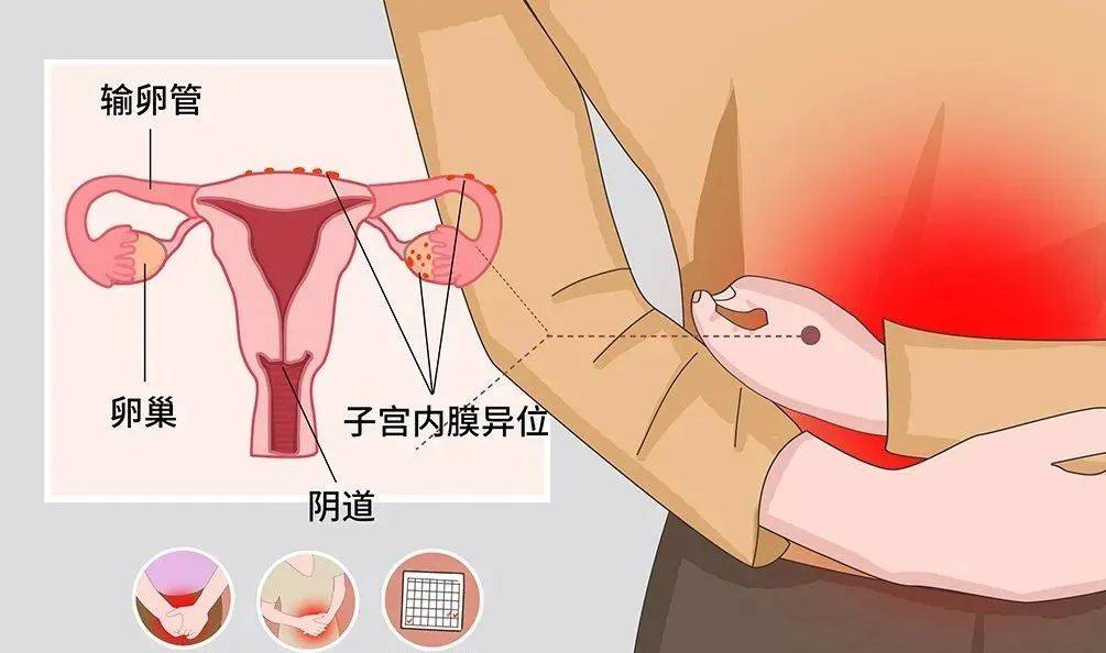 子宫内膜异位症