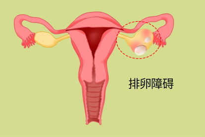 排卵障碍