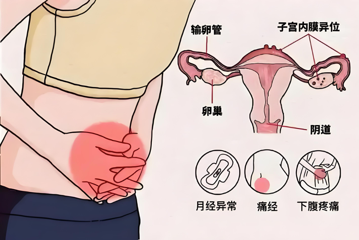 子宫内膜异位症