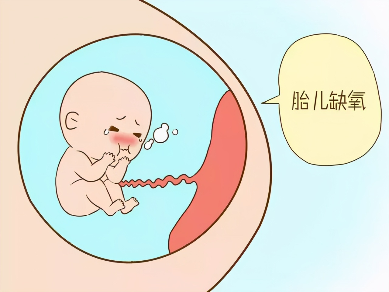 胎儿缺氧