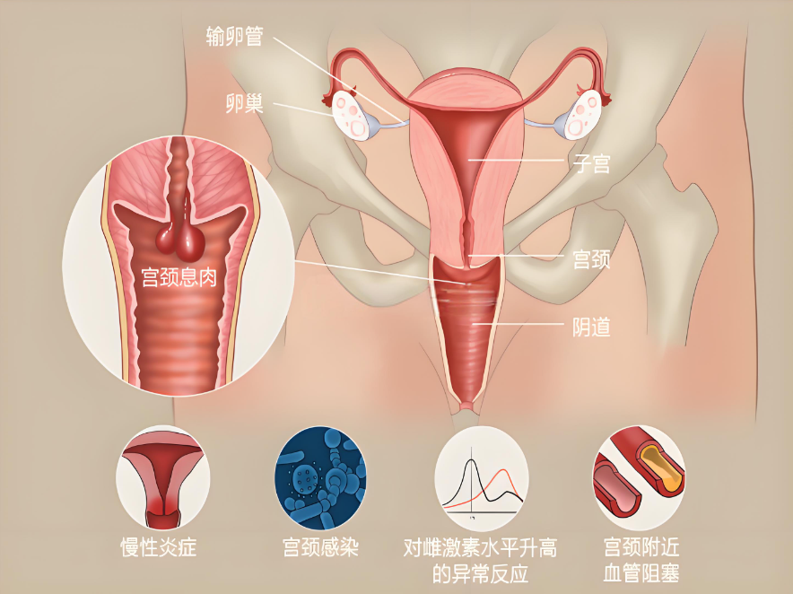 宫颈息肉