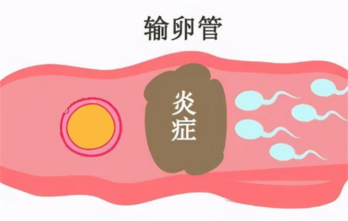 造成输卵管炎症