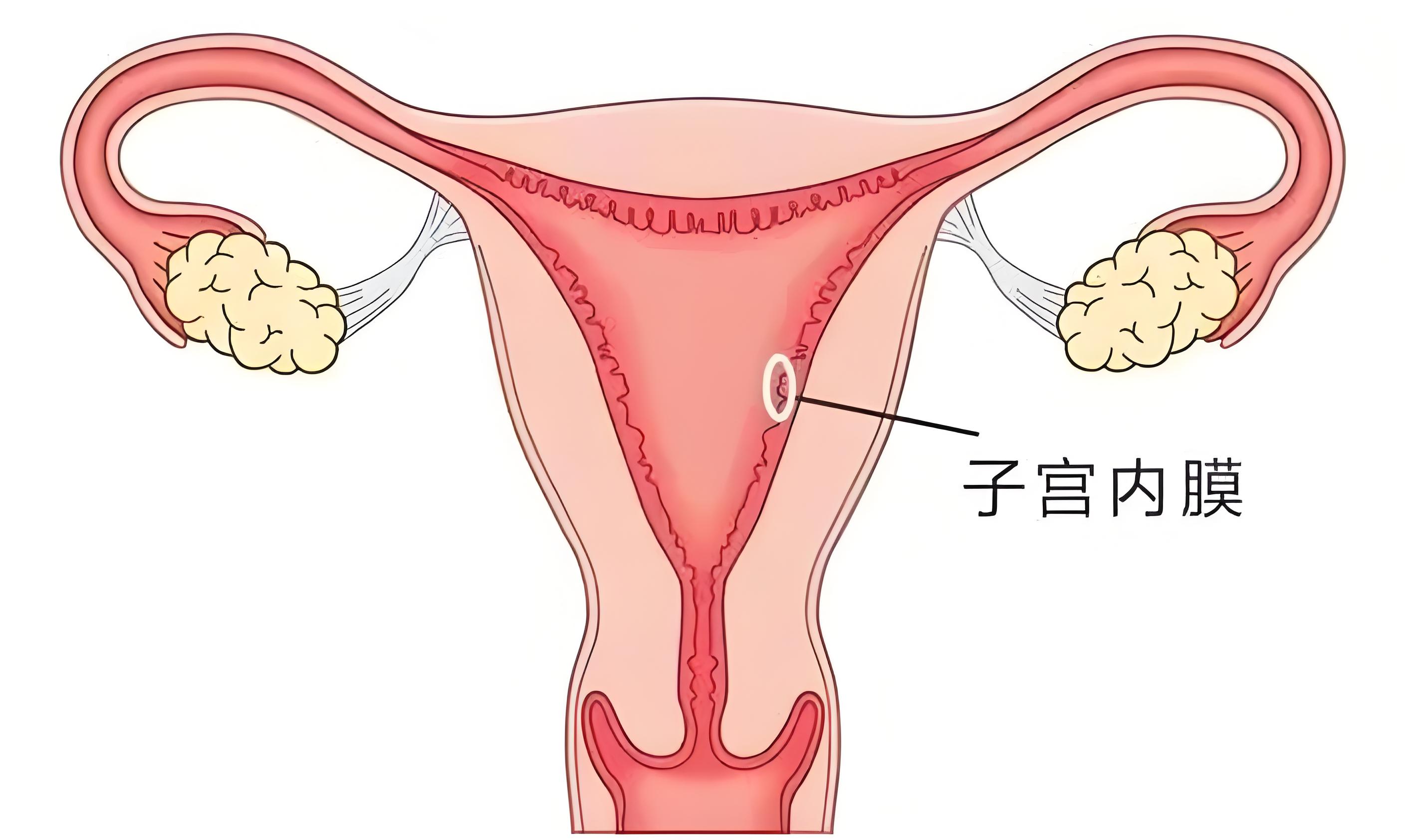 子宫内膜变差