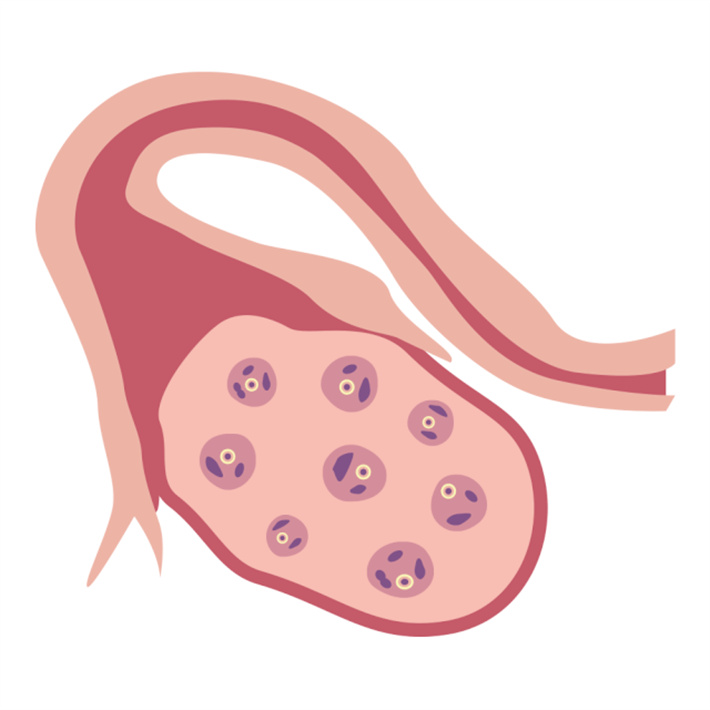 卵巢储备功能衰退