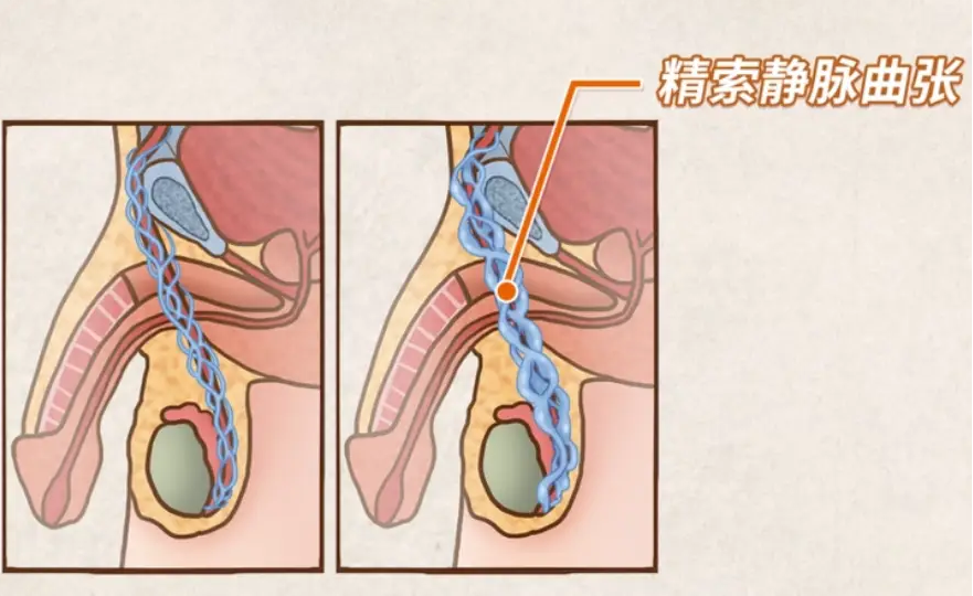 疾病因素精索静脉曲张