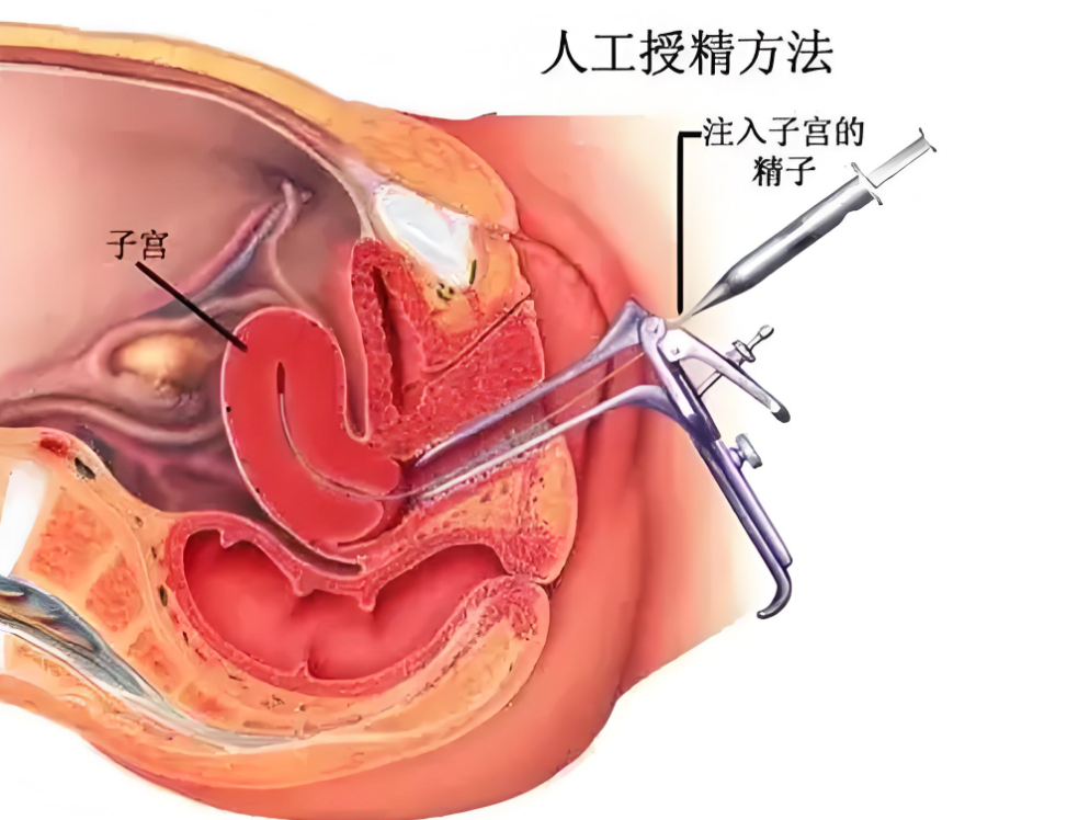 宫腔内人工授精