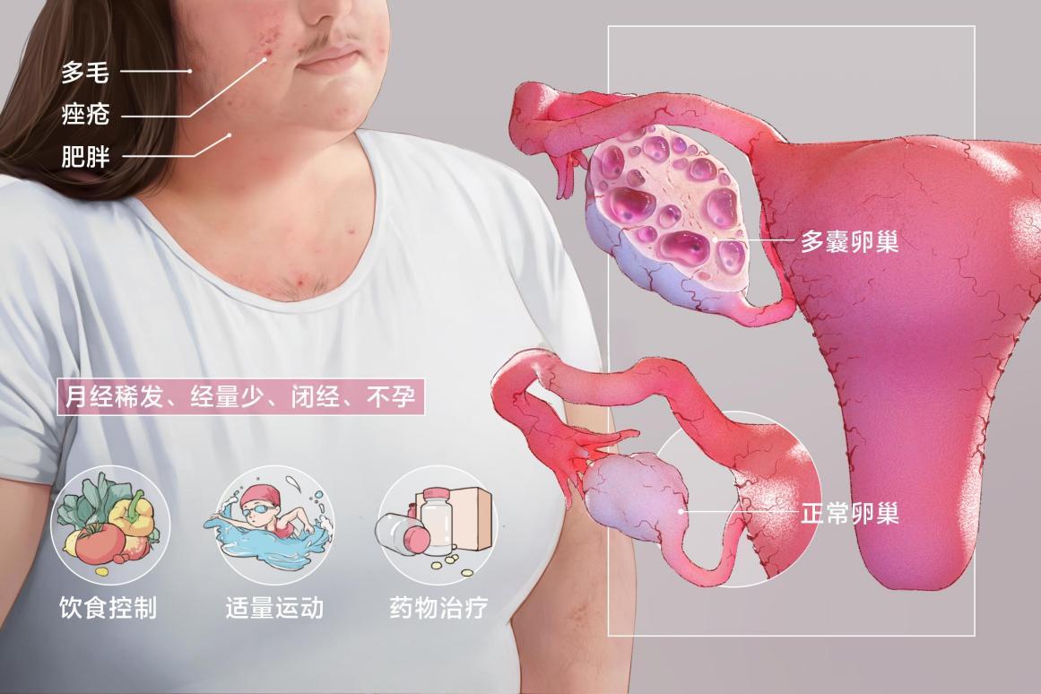 多囊卵巢