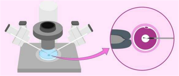 单精子注射技术