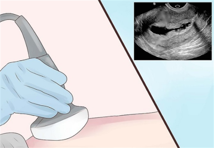 输卵管积水治疗