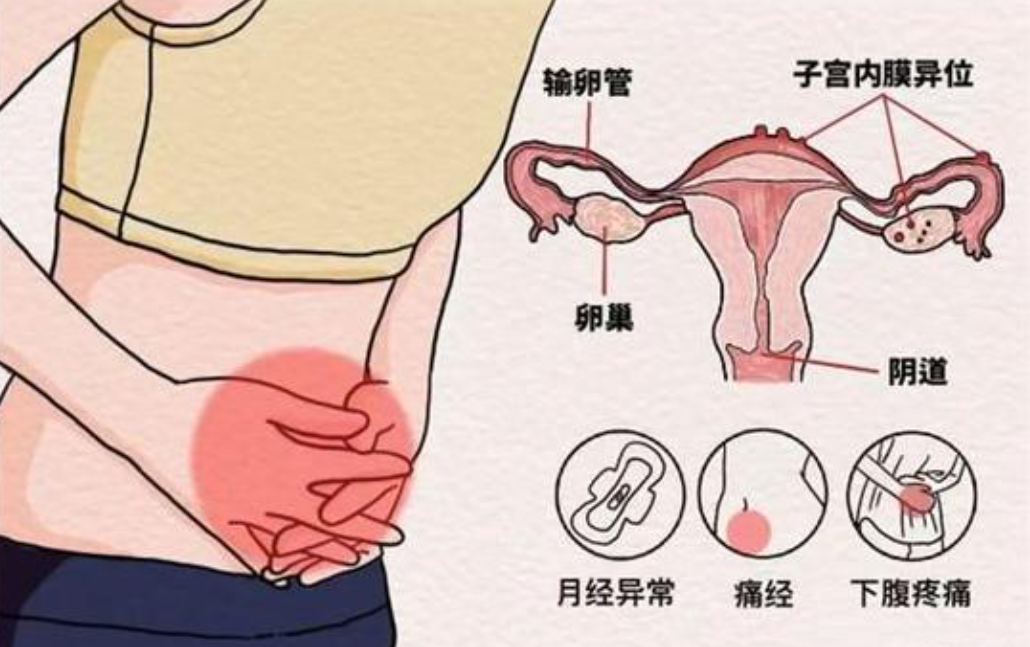 子宫内膜异位症