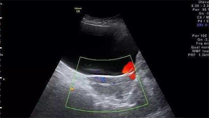 进行阴道B超检查
