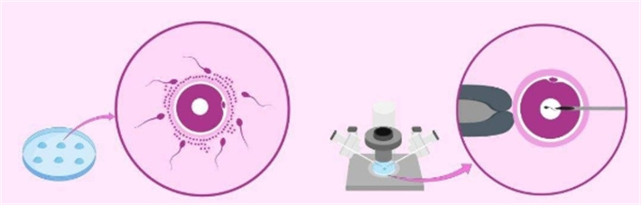 自然受精与单精子注射