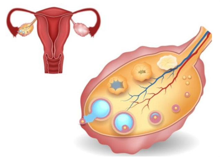 子宫卵巢储备下降