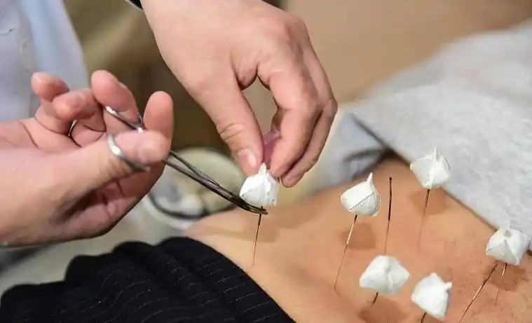 针灸治疗