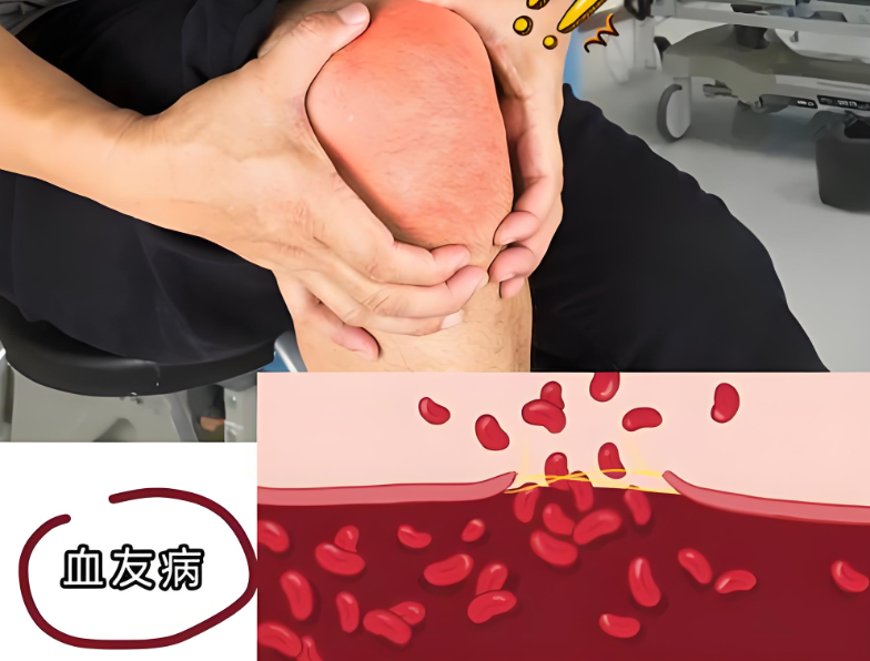 血友病