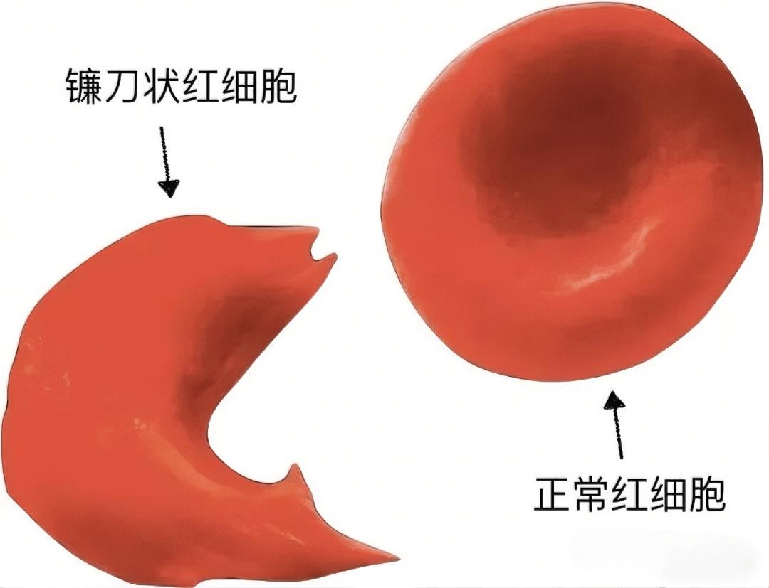 镰刀型细胞贫血症