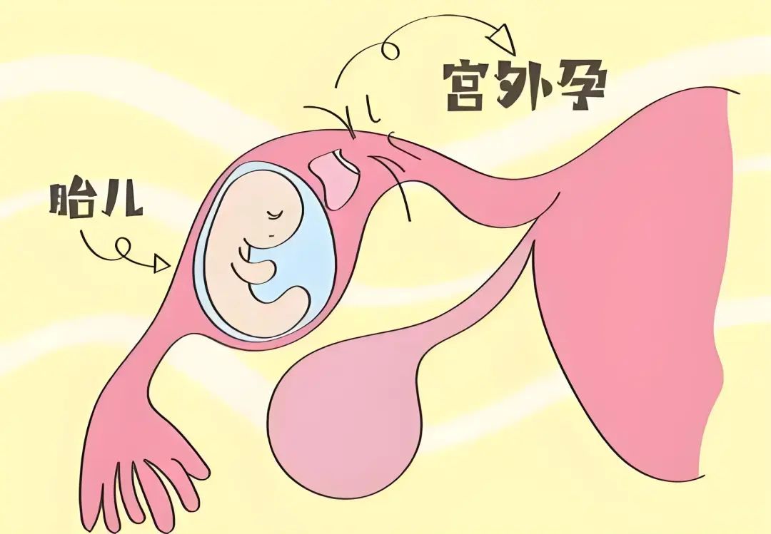 宫外孕