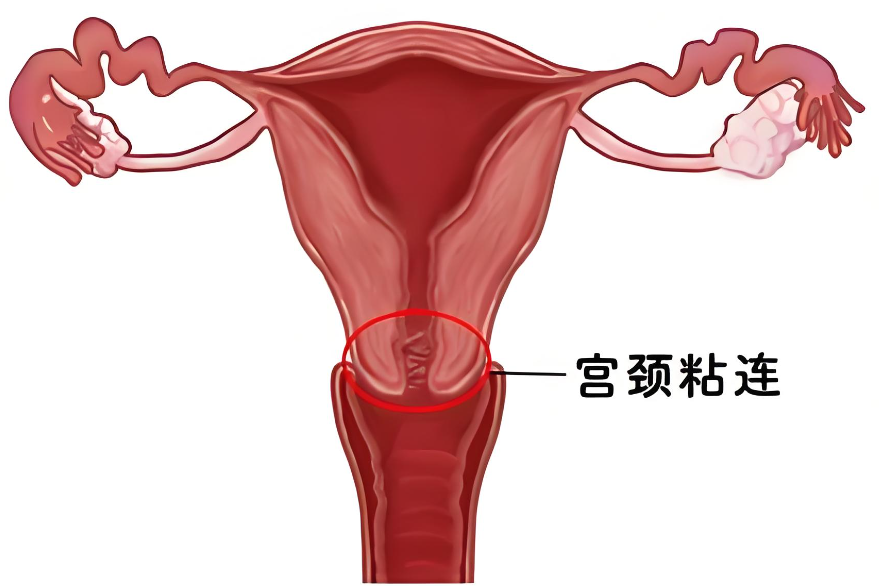 宫颈粘连