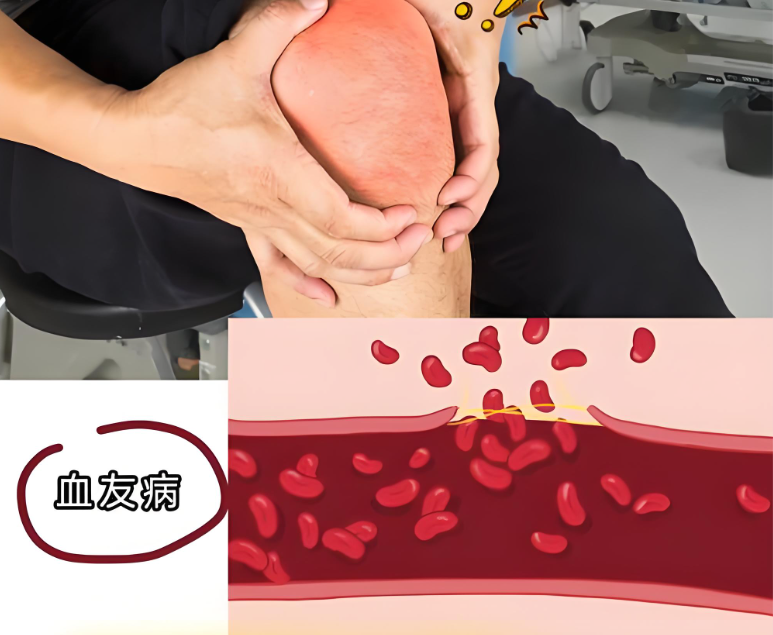 血友病