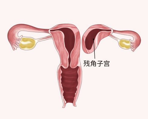 残角子宫