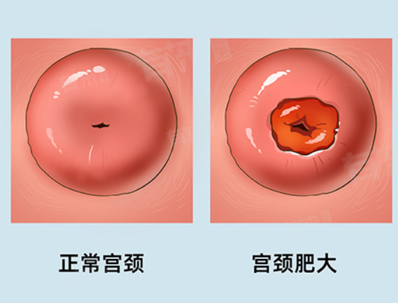 宫颈肥大