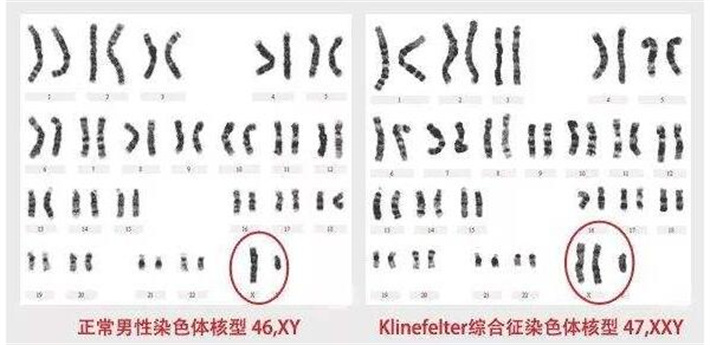 克氏综合症