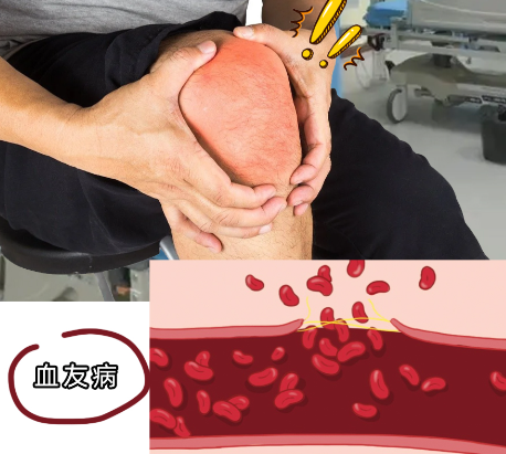 血友病